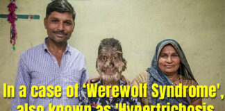 In a case of ‘Werewolf Syndrome', also known as 'Hypertrichosis